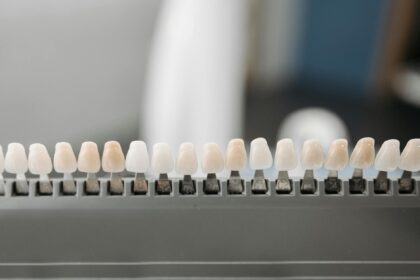 Veneers in der Türkei: Kosten, Qualität & Entscheidungshilfe